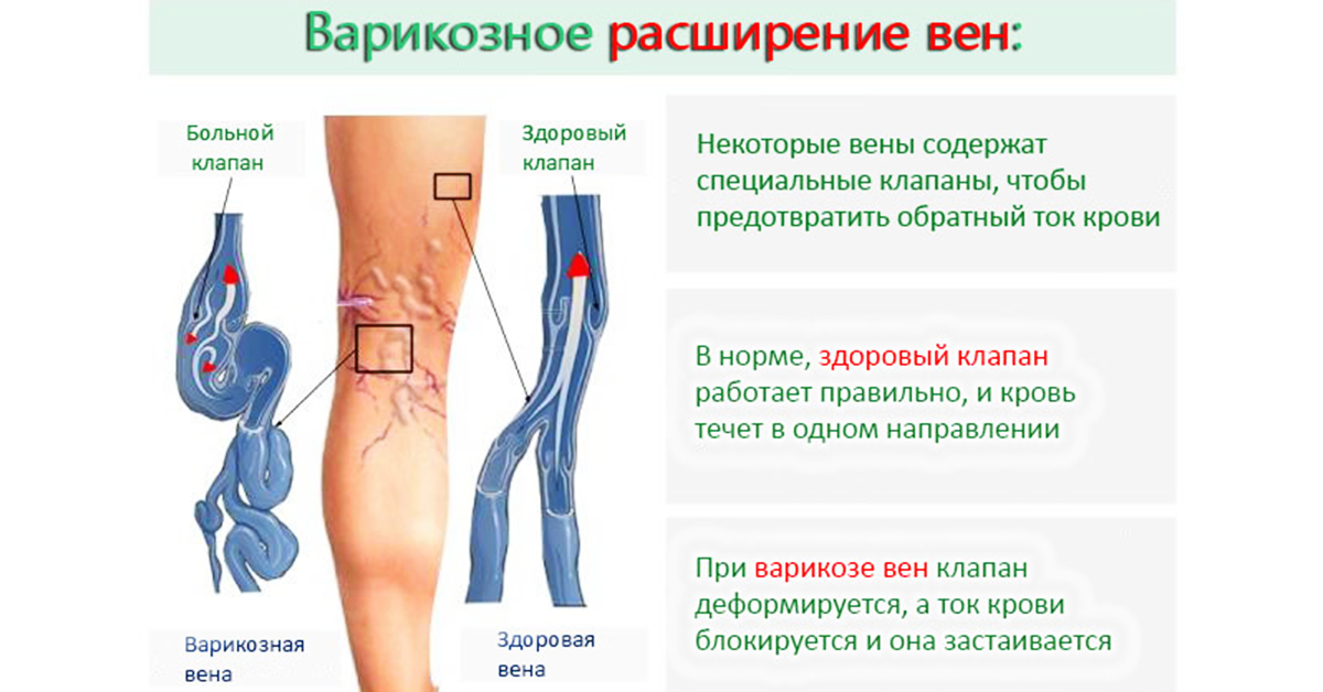 Варикоз Вен На Ногах Врач